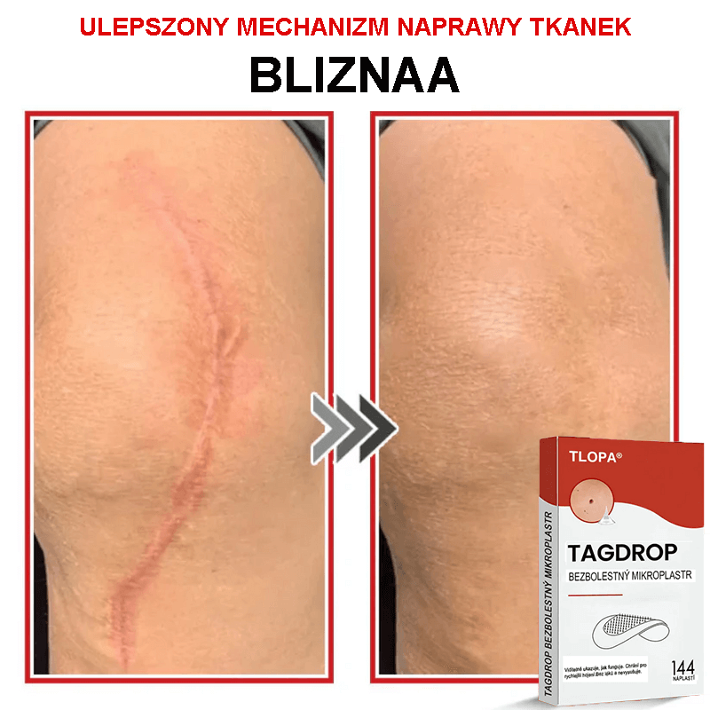Płatek mikroigłowy TLOPA® do usuwania narośli skórnych, wyprodukowany w Polsce