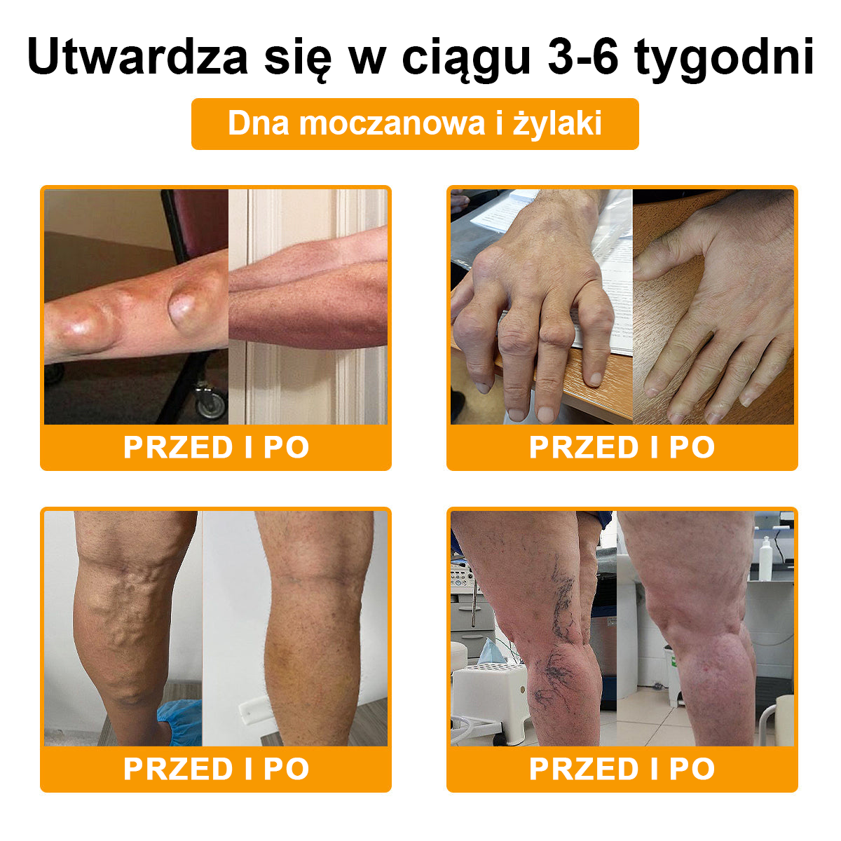 🦴TLOPA® Toksyna botulinowa i jad pszczeli Krem przeciwbólowy do gojenia kości🔥🔥🔥🔥