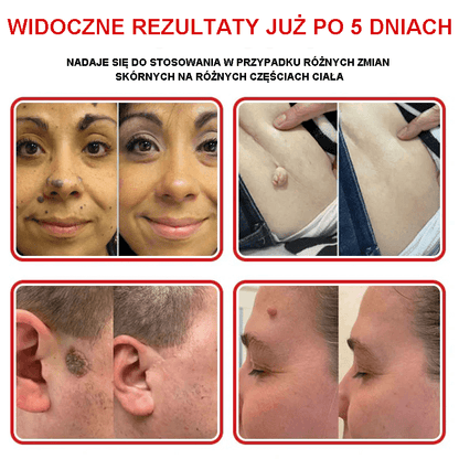 Płatek mikroigłowy TLOPA® do usuwania narośli skórnych, wyprodukowany w Polsce
