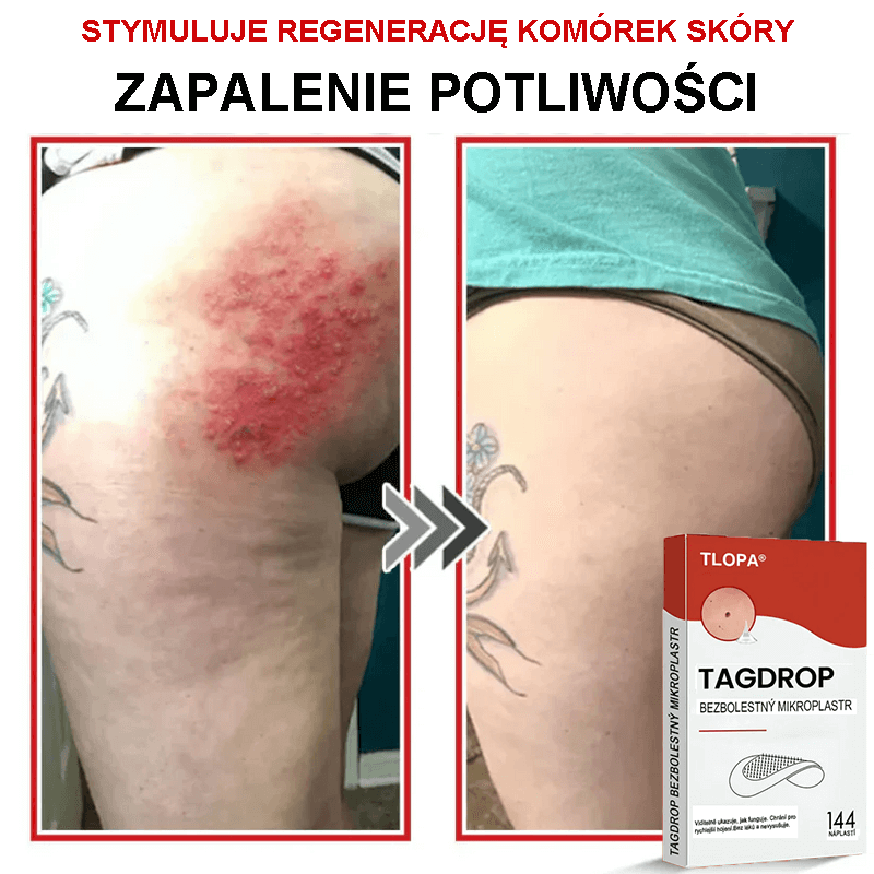 Płatek mikroigłowy TLOPA® do usuwania narośli skórnych, wyprodukowany w Polsce