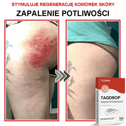 Płatek mikroigłowy TLOPA® do usuwania narośli skórnych, wyprodukowany w Polsce
