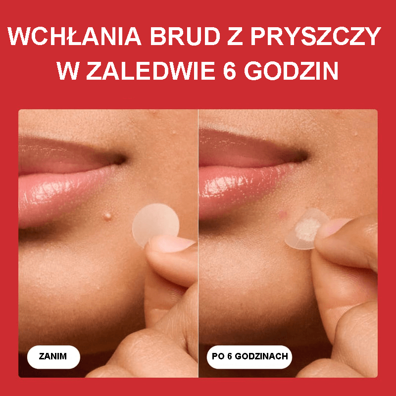 💎Oryginalne plastry – hydrokoloidowe plastry na trądzik nr 1, które zmniejszają wypryski i zaskórniki już po jednym użyciu; Nocne plastry na trądzik do twarzy i skóry (36 sztuk)