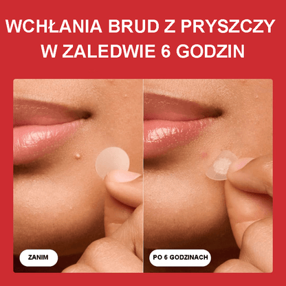 💎Oryginalne plastry – hydrokoloidowe plastry na trądzik nr 1, które zmniejszają wypryski i zaskórniki już po jednym użyciu; Nocne plastry na trądzik do twarzy i skóry (36 sztuk)