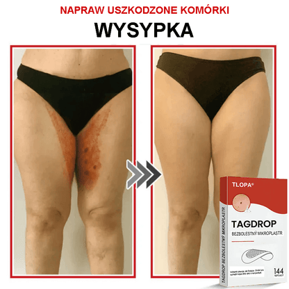 Płatek mikroigłowy TLOPA® do usuwania narośli skórnych, wyprodukowany w Polsce