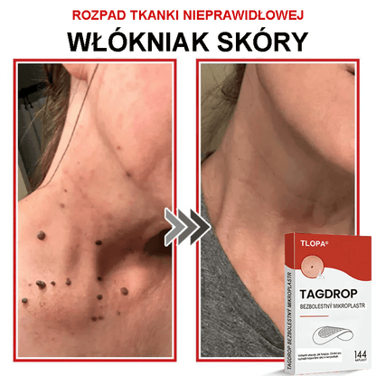 Płatek mikroigłowy TLOPA® do usuwania narośli skórnych, wyprodukowany w Polsce