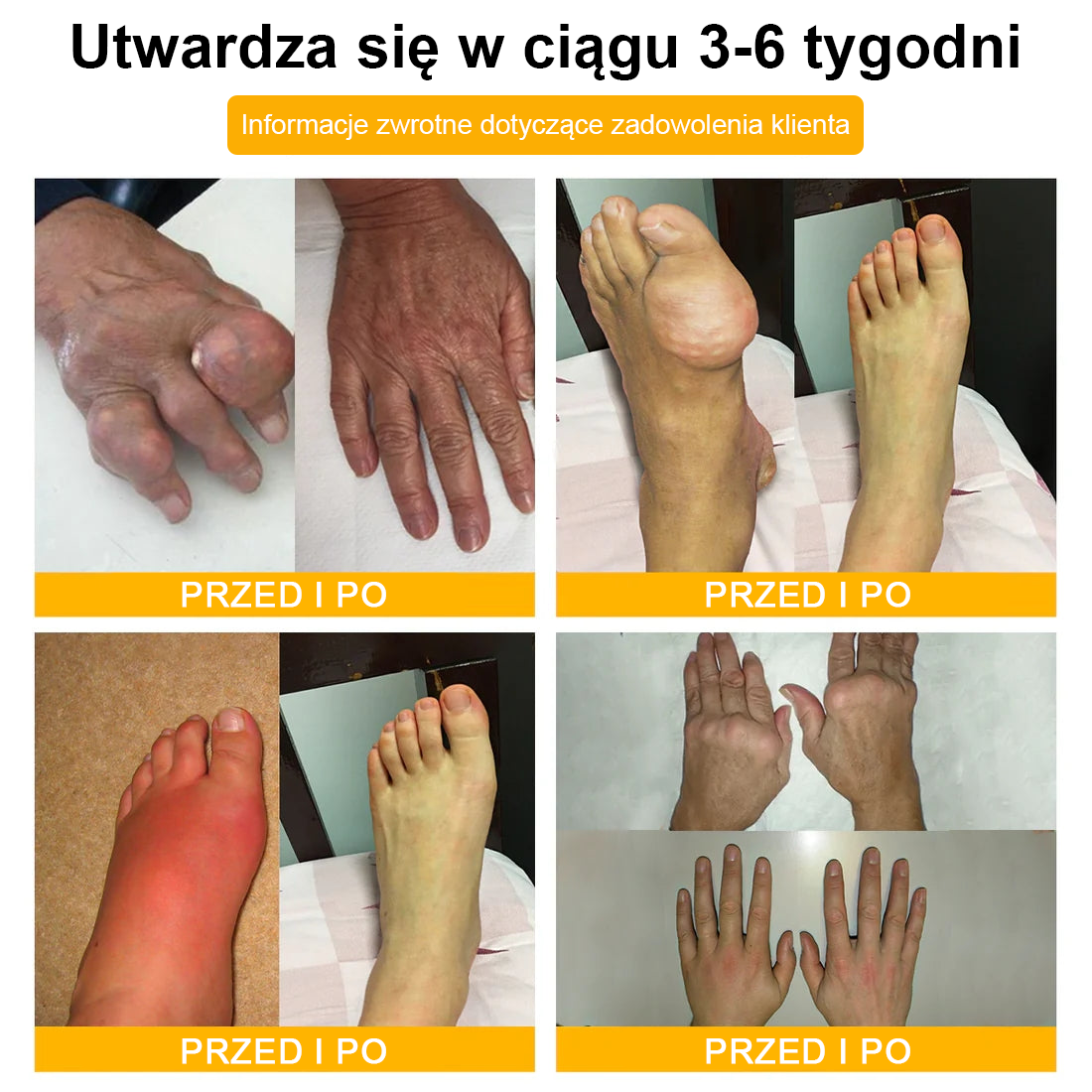 🦴TLOPA® Toksyna botulinowa i jad pszczeli Krem przeciwbólowy do gojenia kości🔥🔥🔥🔥