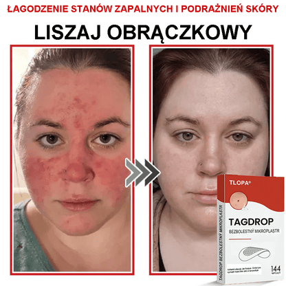 Płatek mikroigłowy TLOPA® do usuwania narośli skórnych, wyprodukowany w Polsce