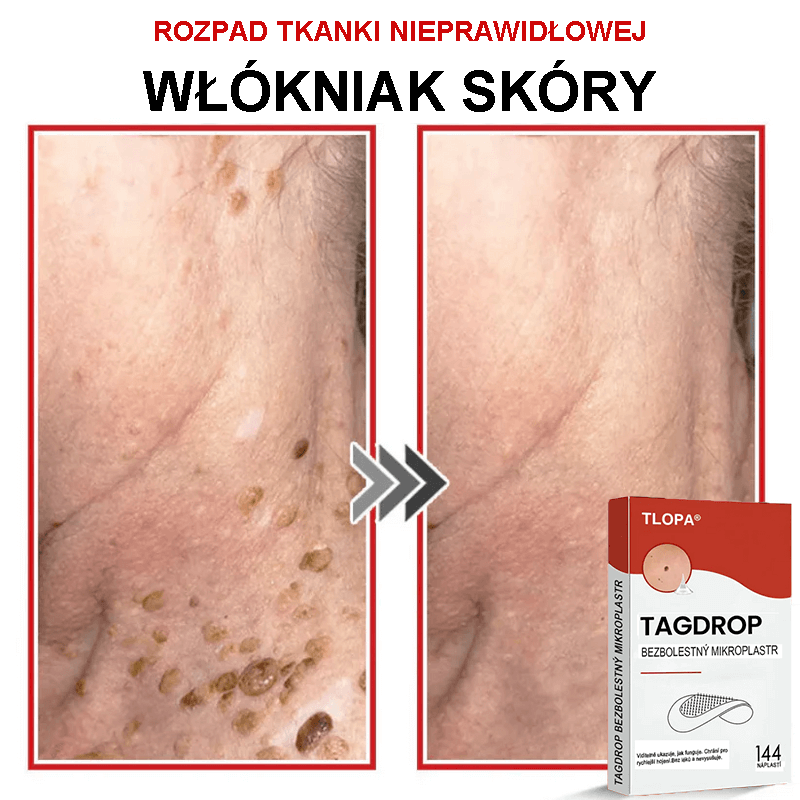 Płatek mikroigłowy TLOPA® do usuwania narośli skórnych, wyprodukowany w Polsce